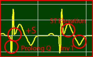 ECG Interpretation Make Simple 10