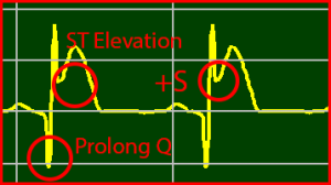 ECG Interpretation Make Simple 11