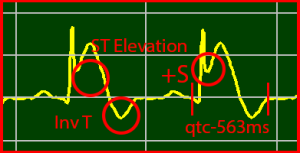 ST-Elevation STEMI Positive S-Wave Inverted-T Wave