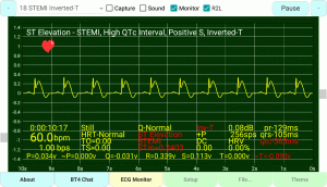 ST-Elevation STEMI Positive S-Wave Inverted-T Wave