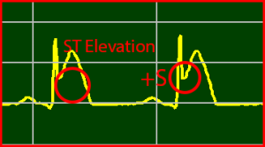 T-Elevation STEMI Positive S-Wave Positive T-Wave