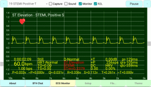 ST-Elevation STEMI Positive S-Wave Positive T-Wave