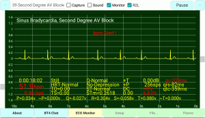 Second-Degree-AV-Block