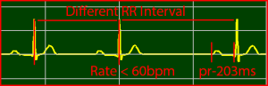 ECG Interpretation Make Simple 29