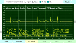 Sinus Arrest or Sinus Pause