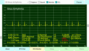 Sinus-Arrhythmia