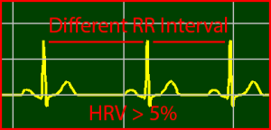 ECG Interpretation Make Simple 19