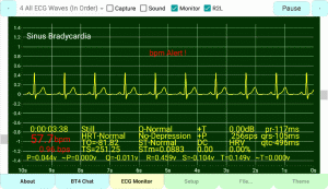 Sinus-Bradycardia