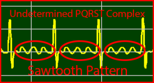 ECG Interpretation Make Simple 23