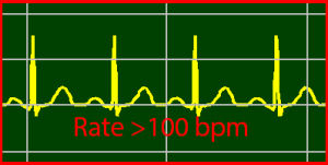 ECG Interpretation Make Simple 21