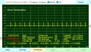 Sinus-Tachycardia