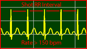 ECG Interpretation Make Simple 26