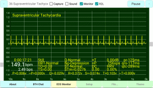 Supraventricular-Tachycardia