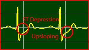 ECG Interpretation Make Simple 4