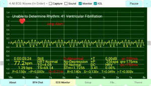 Ventricular-Fibrillation, Undetermined-PQRST-Complex