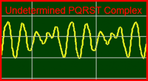 ECG Interpretation Make Simple 31