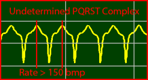 ECG Interpretation Make Simple 27