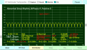 Ventricular-Tachycardia, Undetermined-PQRST-Complex