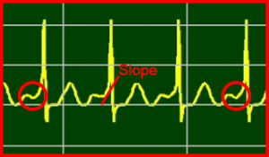 ECG Interpretation Make Simple 30