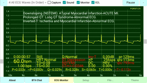 Downsloping-Inverted-T-Myocardial-Ischemia-(NSTEMI)