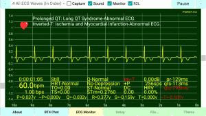 Inverted-T-Wave