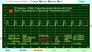 Positive-S-Prolong-T-Wave