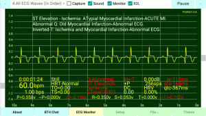 Positive-Horizontal-ST-Inverted-T-Wave