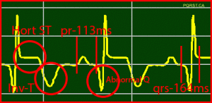 Positive-Horizontal-ST & Inverted-T