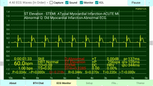 STEMI-Extended-Q-Normalize-ST