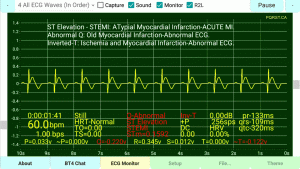 STEMI-Extended-Q-Normalize-ST-Inverted-T-Wave