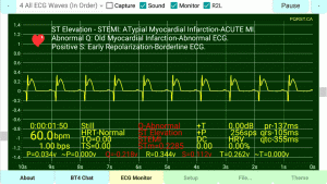 STEMI-Extended-Q-Positive-T-Wave