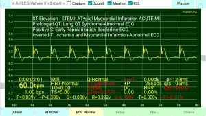 STEMI-Inverted-T-Wave