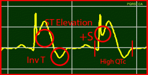 ST-Elevation STEMI Positive S-Wave Inverted-T Wave