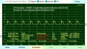 STEMI-Positive-T-Wave