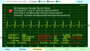 ST-Recovery-Inverted-T-Wave