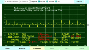 ST-Recovery-Normal-T-Persistent-Q-Wave