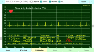 Sinus-Arrhythmia