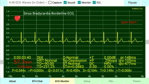 Sinus-Bradycardia