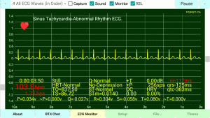 Sinus-Tachycardia