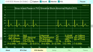 Sinus-Arrest-or-Sinus-Pause