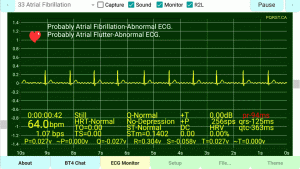 Atrial-Fibrillation