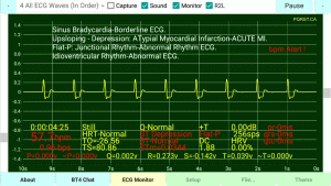 Idioventricular-Rhythm