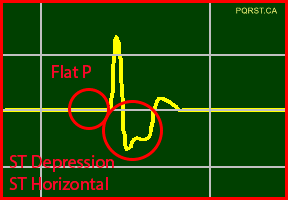 Idoventricular-Rhythm