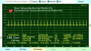 Supraventricular-Tachycardia