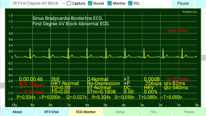 First-Degree-AV-Block