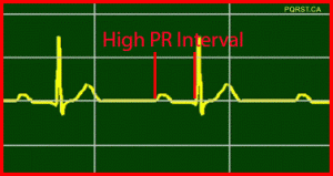 First-Degree-AV-Block