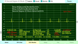 Second-Degree-AV-Block