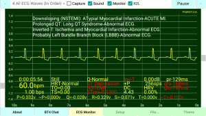 Left-Bundle-Branch-Block