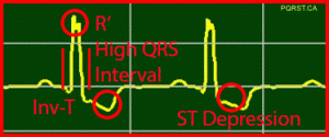 Osborn-Wave, Undetermined-PQRST-Complex