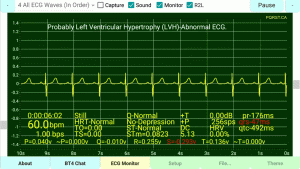 Left-Ventricular-Hypertrophy